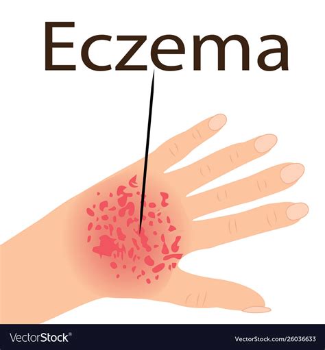 Eczema affected a hand dermatology skin disease Vector Image