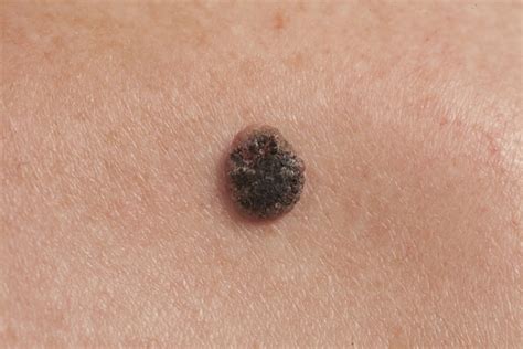 How to tell if a mole is cancerous - Harris Dermatology