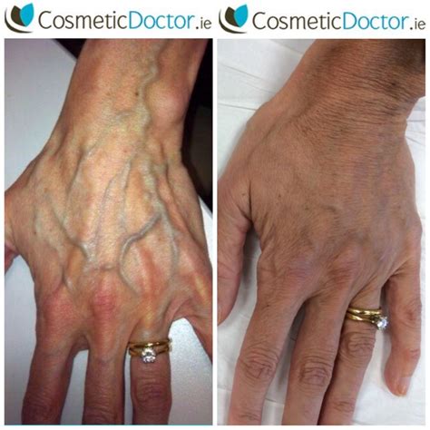 Dermal Fillers for Hand - Hand rejuvenation in Dublin | Cosmetic Doctor Dublin