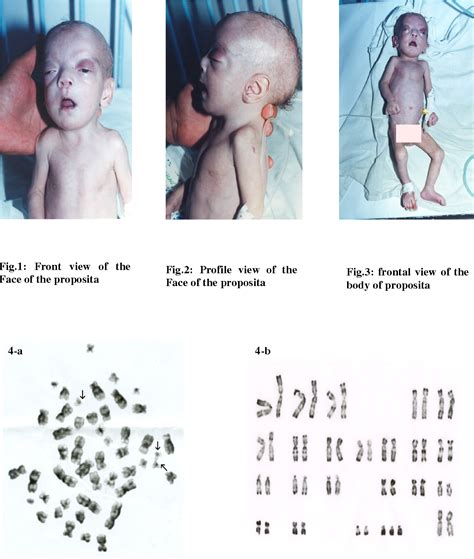 Figure 4 from MOSAIC TRISOMY 22 IN A MALFORMED NEWBORN FEMALE : A NEW ...