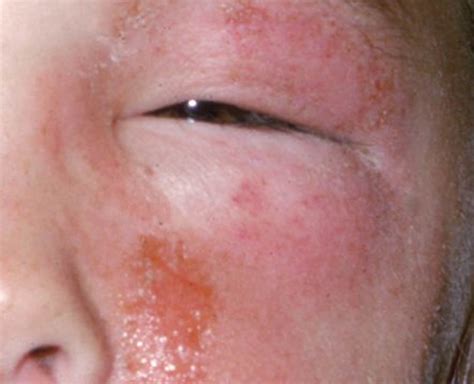 Poison Ivy Rash - Causes, How To Identify Poison Ivy Rash & Treatment