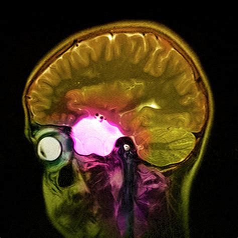 Arachnoid Cyst Photograph by Simon Fraser/science Photo Library - Pixels