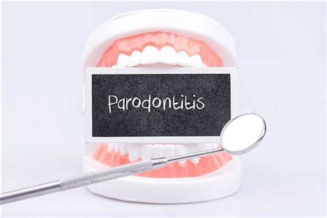 Periodontitis: New treatment option discovered - News - 2023