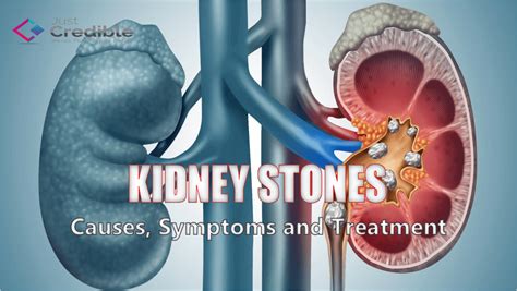 Kidney Stones: Causes, Symptoms and Treatment Options - Just Credible