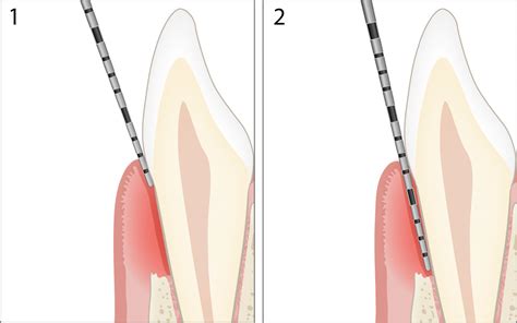 Printable Periodontal Probing Chart