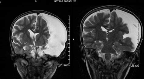 Case study: Shunt relieves pressure from arachnoid brain cyst, allowing ...