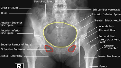 Hip X-ray Interpretation - OSCE Guide | Geeky Medics