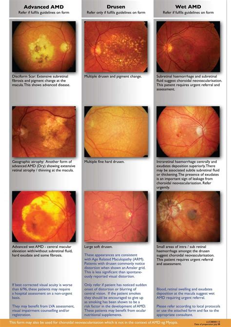 Advanced AMD Drusen Wet AMD