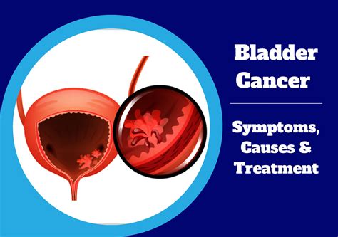 Bladder Cancer : Symptoms, Causes & Treatment | UroLife Clinic