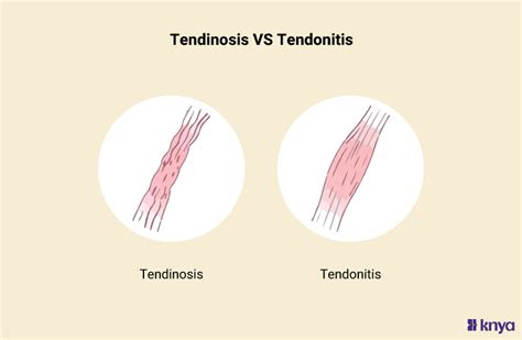 Tendinosis vs. Tendonitis: Key Differences Explained! – Knya