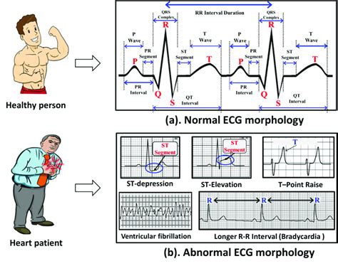 Normal Ecg Reading