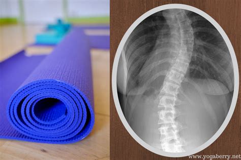 How yoga can help with scoliosis - Yogaberry