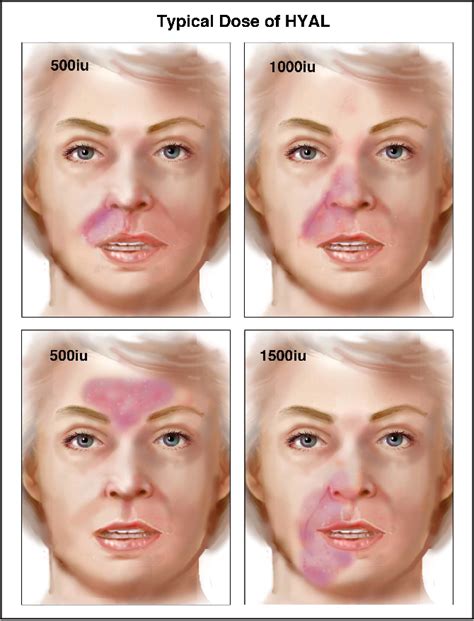 Figure 4 from New High Dose Pulsed Hyaluronidase Protocol for Hyaluronic Acid Filler Vascular ...