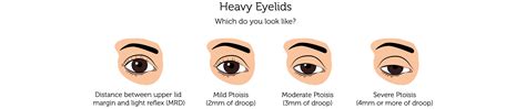 Heavy Eyelids | London | Rejuvence Clinic