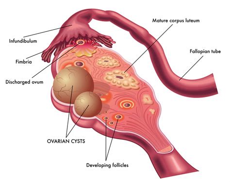 Ovarian Cyst Symptoms: How They Develop, How to Treat Them - University Health News