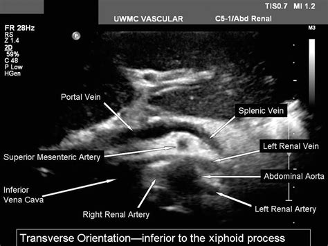 Renal Artery Duplex Ultrasound