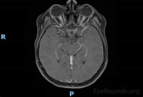 Myelin Oligodendrocyte Glycoprotein (MOG)-IgG Associated Optic Neuritis