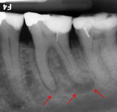 Abscessed_tooth_periapical_radiograph – Ace Achievers