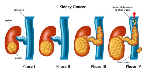 Kidney Cancer - Sunrise Urology