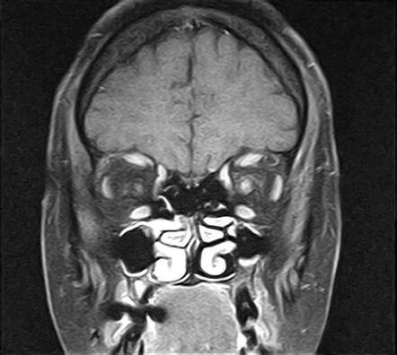 Optic neuritis | Radiology Case | Radiopaedia.org