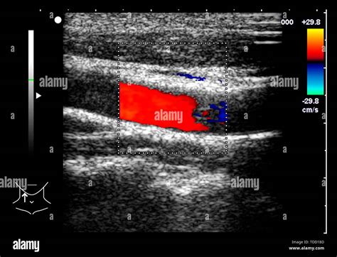 Carotid artery, doppler ultrasound scan Stock Photo - Alamy