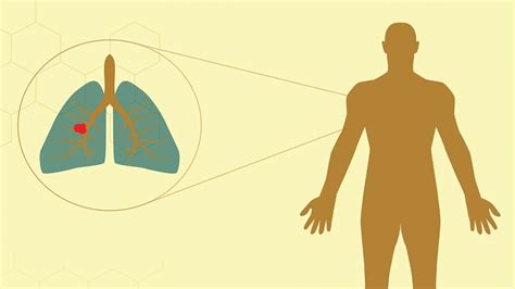 Lung Cancer Treatment Modalities Explained – Medical & Health Tourism ...