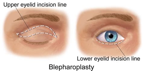 The Definitive Guide to Eyelid Surgery | Resources | Milan Eye Center