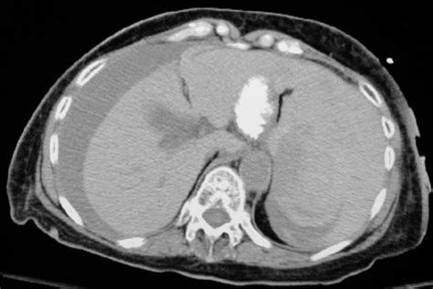 Figure 1:Rare Complications Following Colonoscopy: Case Reports of Splenic Rupture and ...