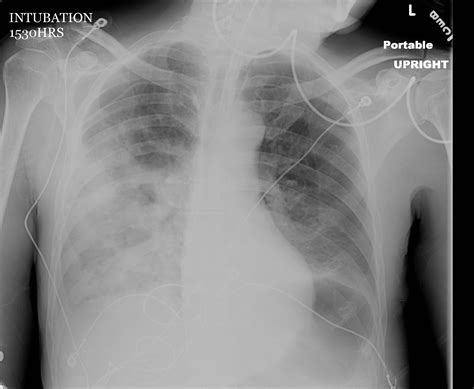 [DIAGRAM] Diagram Pneumonia X Ray - MYDIAGRAM.ONLINE