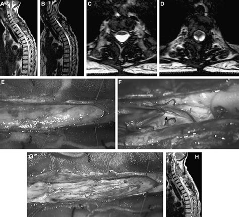 Spinal arachnoid cyst | Neurosurgery Blog