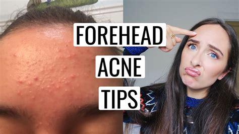 How To Get Rid Of FOREHEAD ACNE 🙌🏻 - YouTube