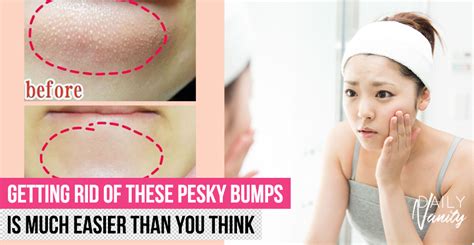 Bumps on chin: Here are 5 ways to get rid of closed comedones