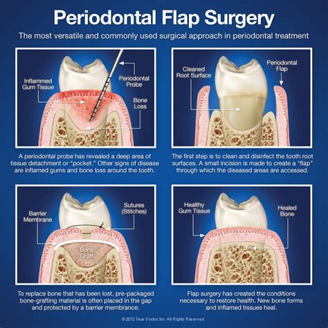 periodontal-flap-surgery - Winslow Dental