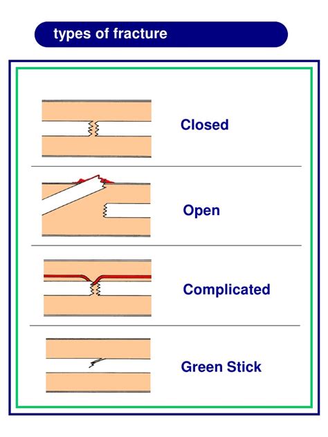 Types of Fracture first aid – First aid for free