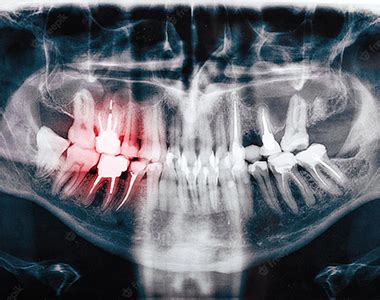 Dental x-ray | Arch Dental