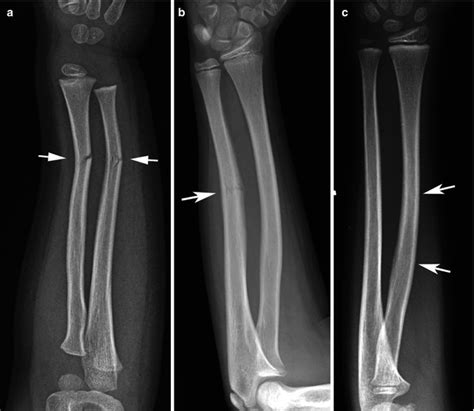 Types of Fractures in Children | Radiology Key