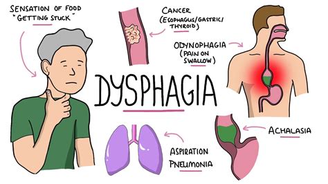 Dysphagia - Oropharyngeal & Esophageal Dysphagia (Causes/Differential Diagnosis, Signs ...