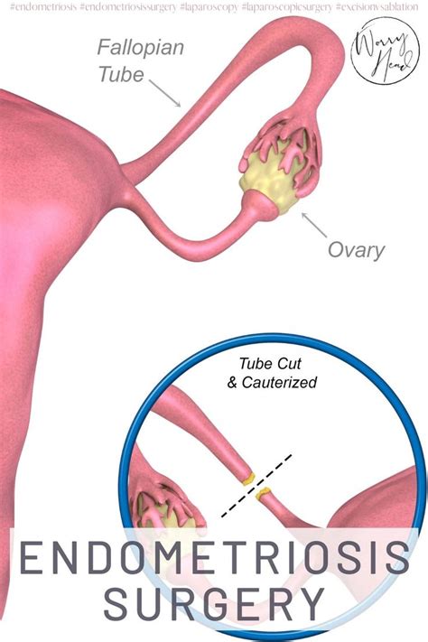 Endometriosis Surgery