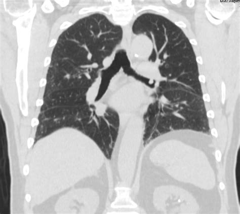 000 Hamartoma | Lungs