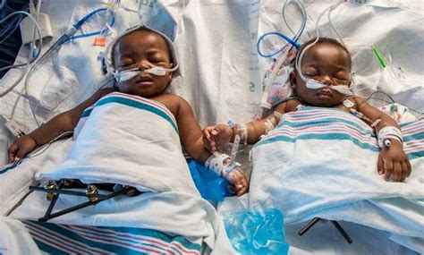 Conjoined twins separated after 18-hour surgery - News - Emirates24|7