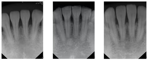 Periapical X Ray