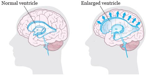 Ventriculoperitoneal Shunt Complications