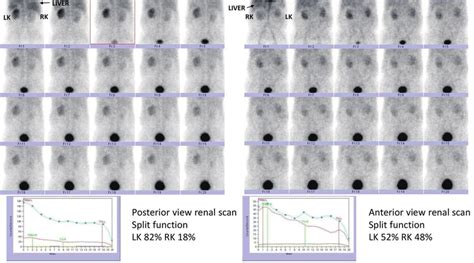 (a) The split function calculated by Tc-99m-DTPA renal scan in ...