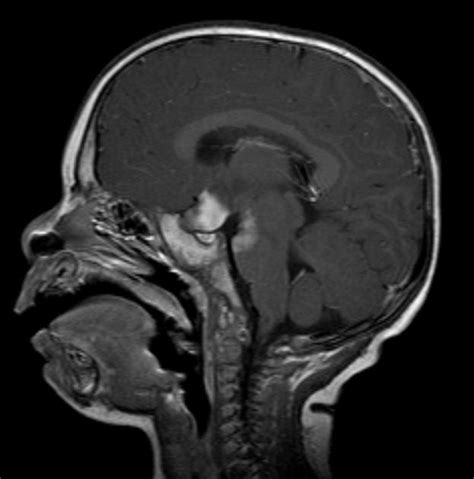 Optic nerve glioma MRI - wikidoc