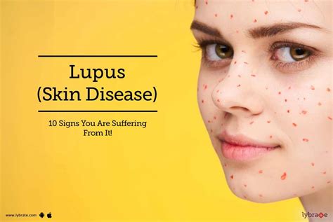 Lupus (Skin Disease) - 10 Signs You Are Suffering From It! - By Dr ...