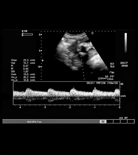 When Can You Hear Fetal Heartbeat: A Week-by-Week Chart