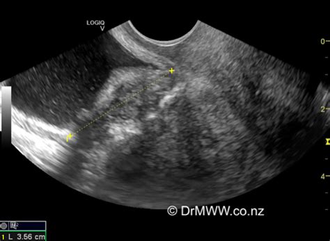 Endometriosis and the Urinary Tract