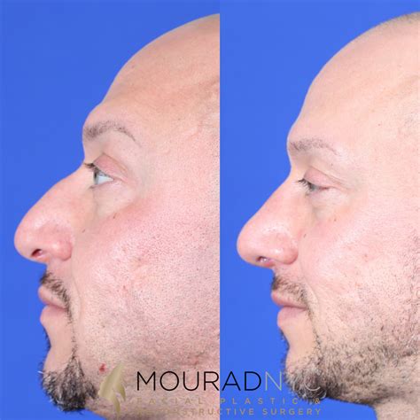 Male Deviated Septum / Rhinoplasty Before and After | Facial Plastic ...