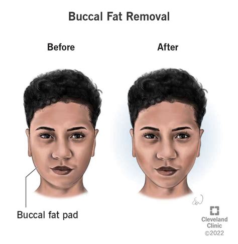 Buccal Fat Removal: What It Is, Recovery & Before & After