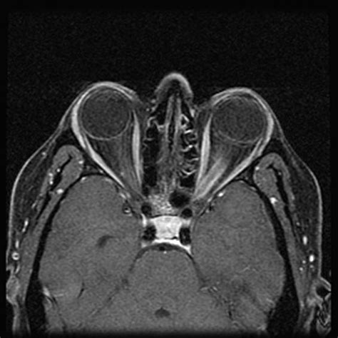 Optic Nerve Neoplasms; Optic Nerve Sheath Tumors